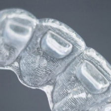 3 Side Effects of In-home Whitening Products